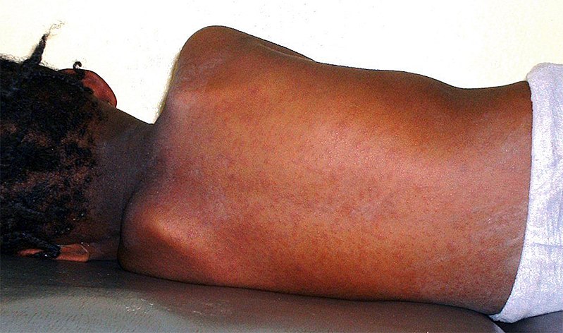 La rougeole